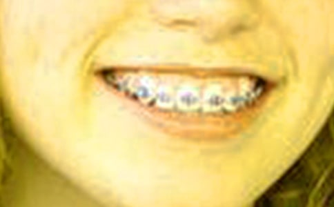 牙套记-初一记事